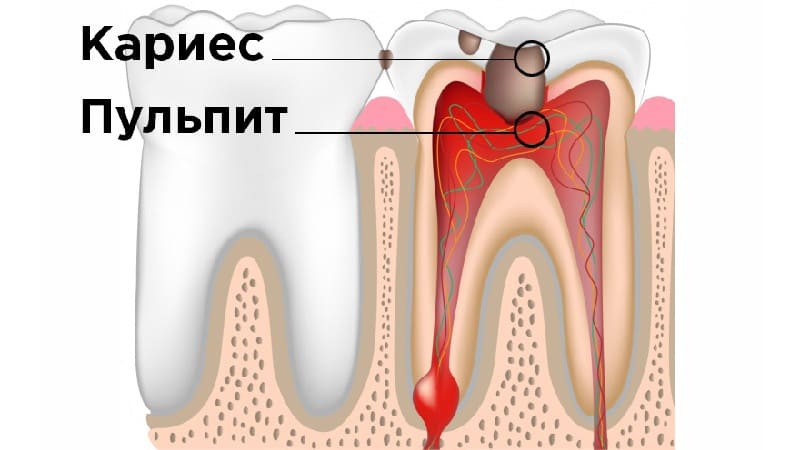 Лечение пульпита или удаление зуба?